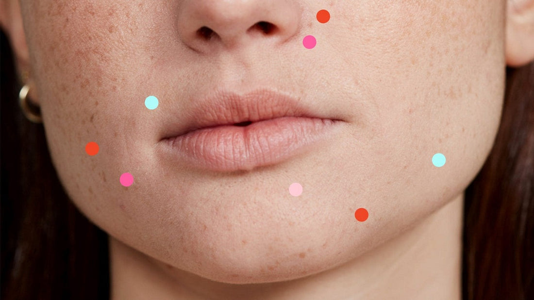 tim-hieu-nguyen-nhan-gay-mun-o-tung-vi-tri-tren-mat-de-dieu-tri