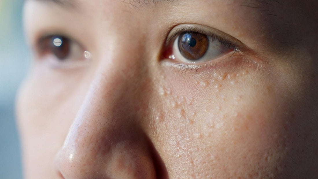 tri-mun-thit-quanh-mat-hieu-dung-ve-nguyen-nhan-de-xu-ly-hieu-qua-hon