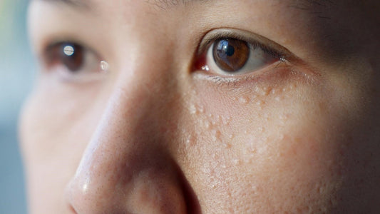 tri-mun-thit-quanh-mat-hieu-dung-ve-nguyen-nhan-de-xu-ly-hieu-qua-hon